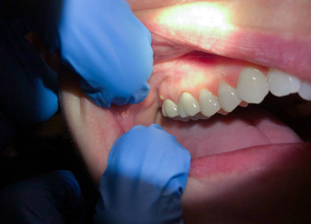 Best Emergency Treatment for Toothache in Boonville, MO